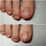 leczenie wrastających paznokci przed i po